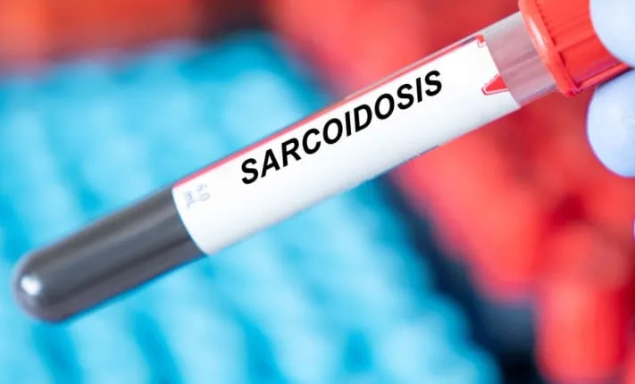 New insights into the development of sarcoidosis