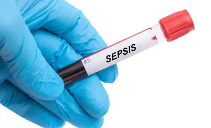 Blood analysis predicts sepsis and organ failure in children blood analysis