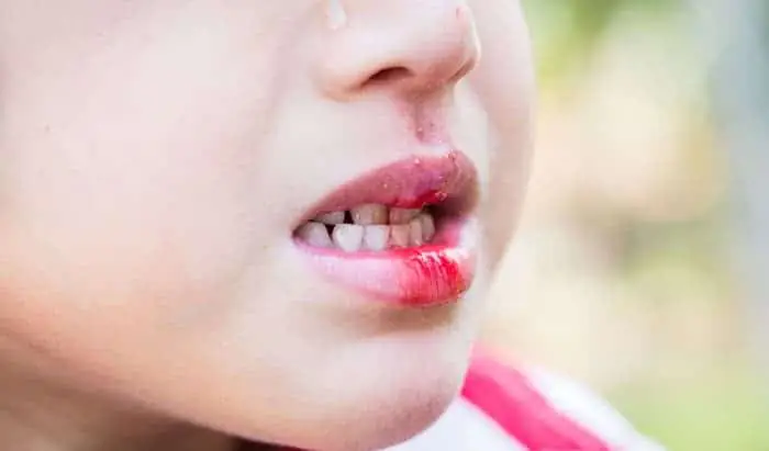How to save a knocked out tooth tooth