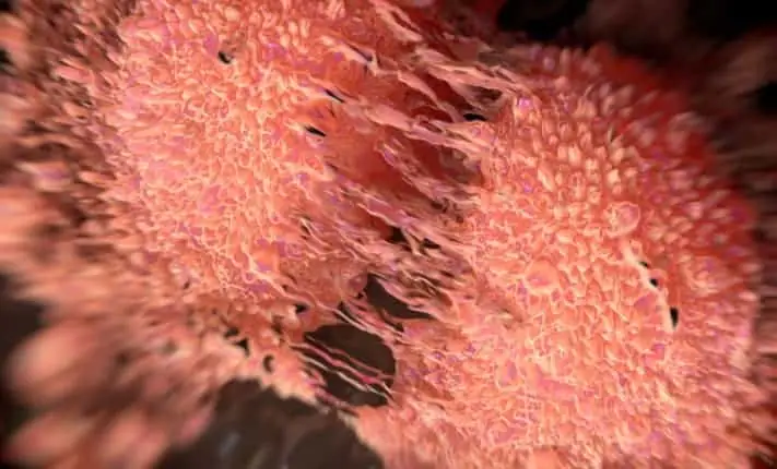 New insight into combatting drug-resistant prostate cancer