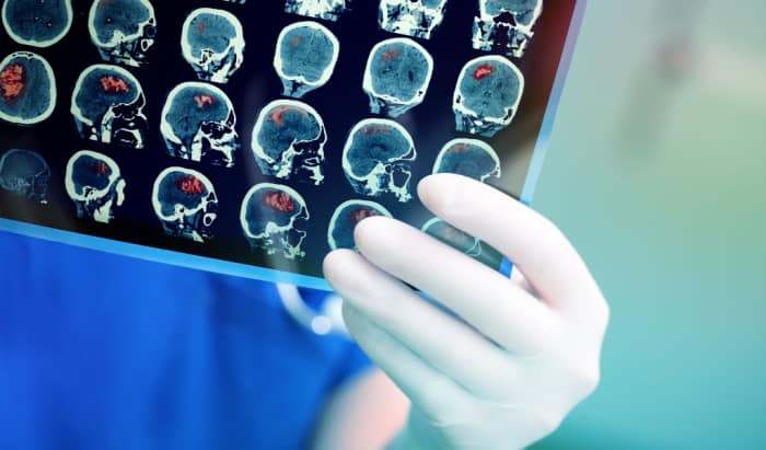 Head and neck cancer: Markers to facilitate better treatment