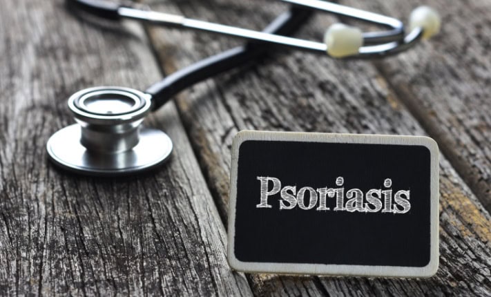 New treatment option for psoriasis discovered