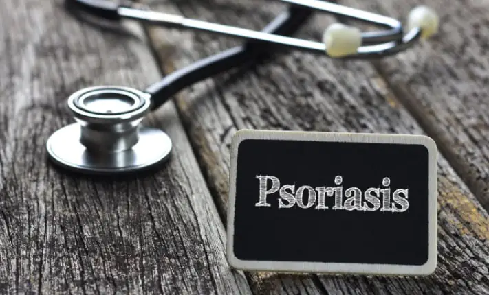 New treatment option for psoriasis discovered psoriasis