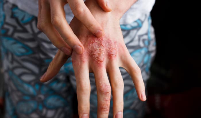 Atopic dermatitis: viruses discovered as new therapy option