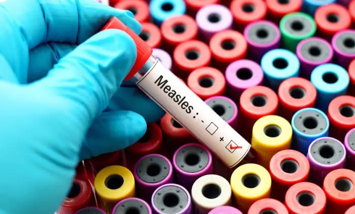 Earlier measles vaccine could help curb global outbreak Earlier measles vaccine