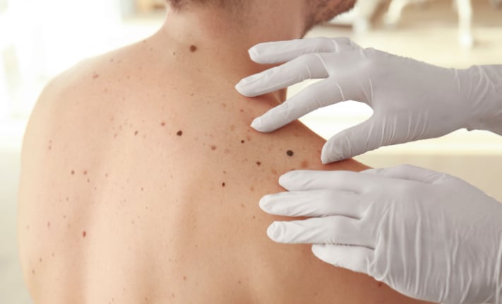 Potential genetic screening for aggressive melanoma
