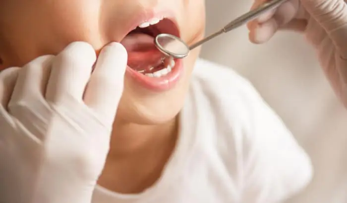 Tooth decay reason for child hospital admissions tooth