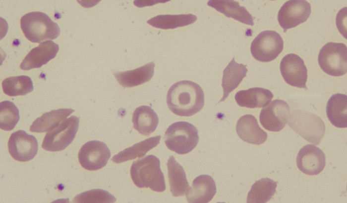Sickle cell patients to benefit from £1.5m technology investment from NHS England