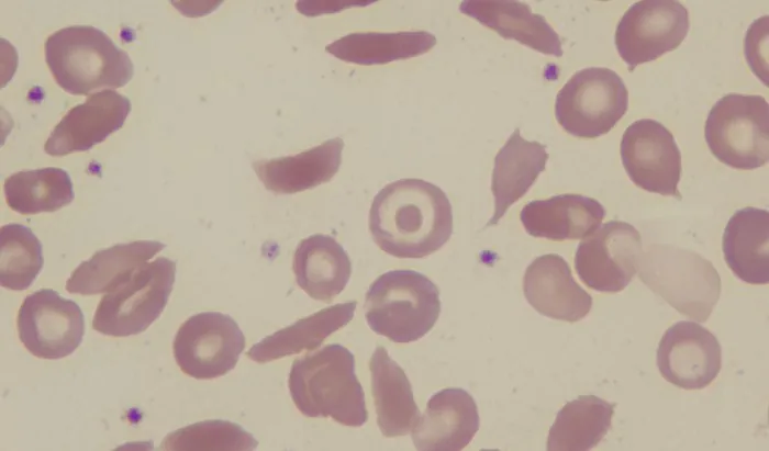 Sickle cell patients to benefit from £1.5m technology investment from NHS England