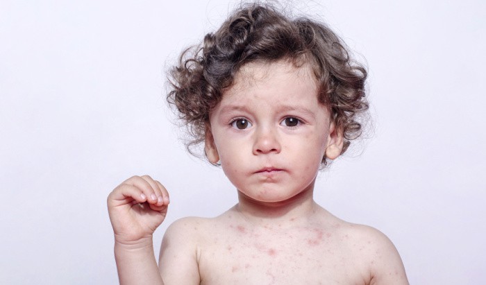 Measles – The outbreak you need to know about