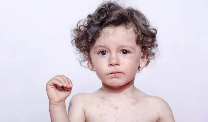 Mumps, measles and hand, foot and mouth disease