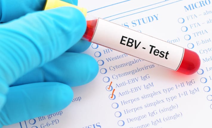 Multiple sclerosis and Epstein-Barr virus: Possible basis for vaccine