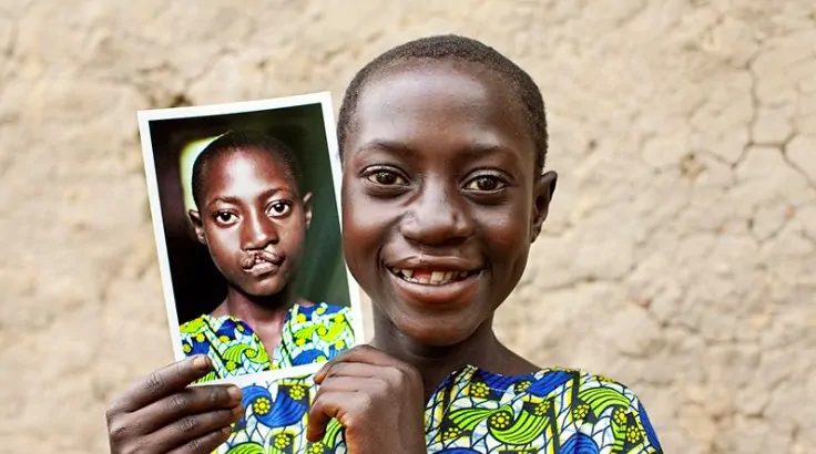Operation Smile