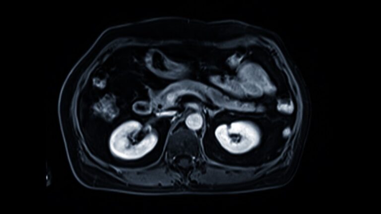 New protocol to stage pancreatic cancer