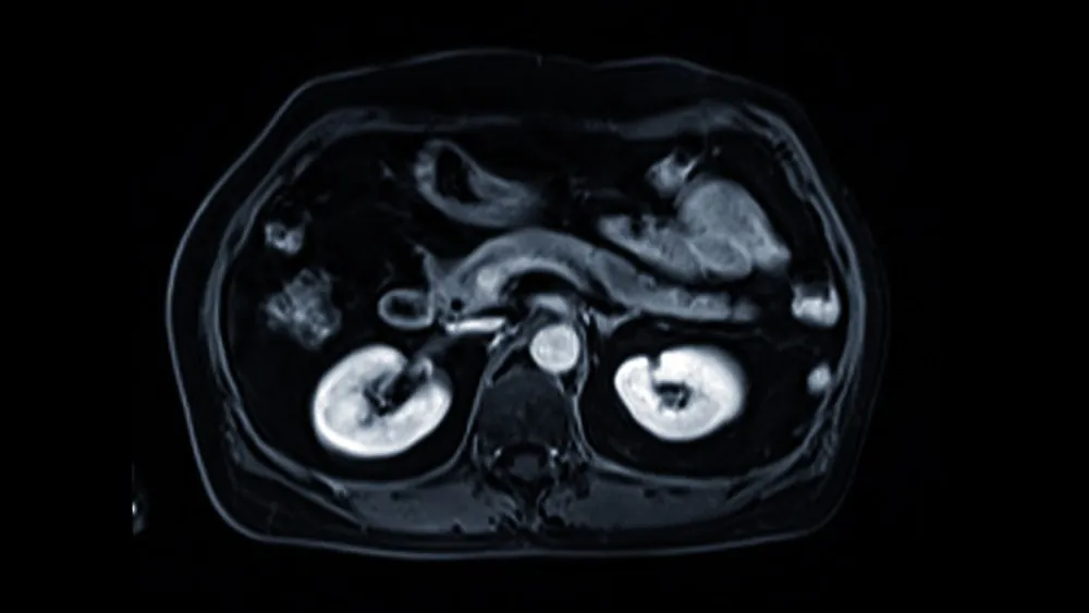 New protocol to stage pancreatic cancer