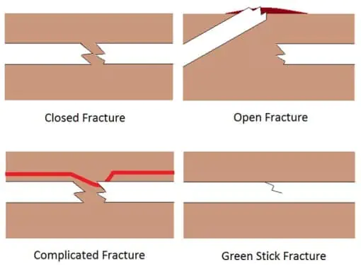different types of fractures