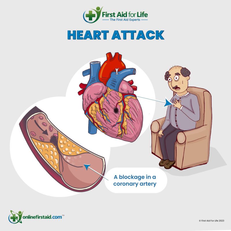 heart attack