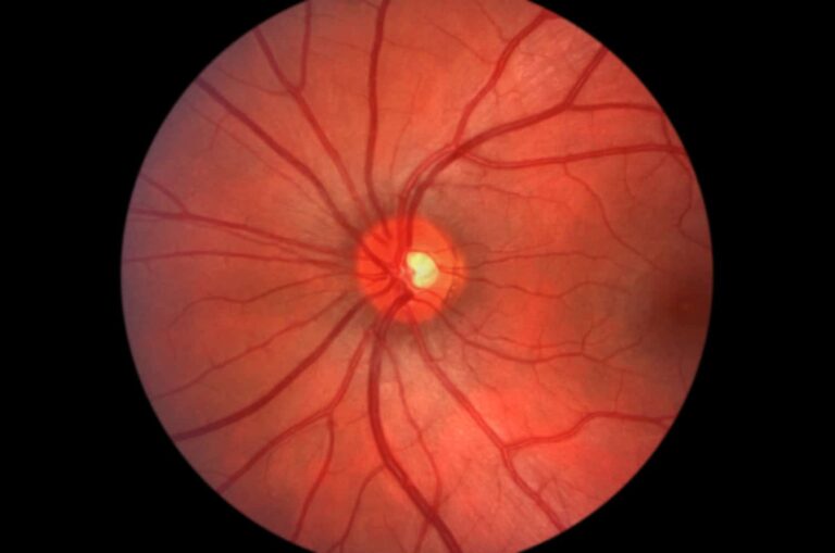 Gene therapy: glaucoma and dementia