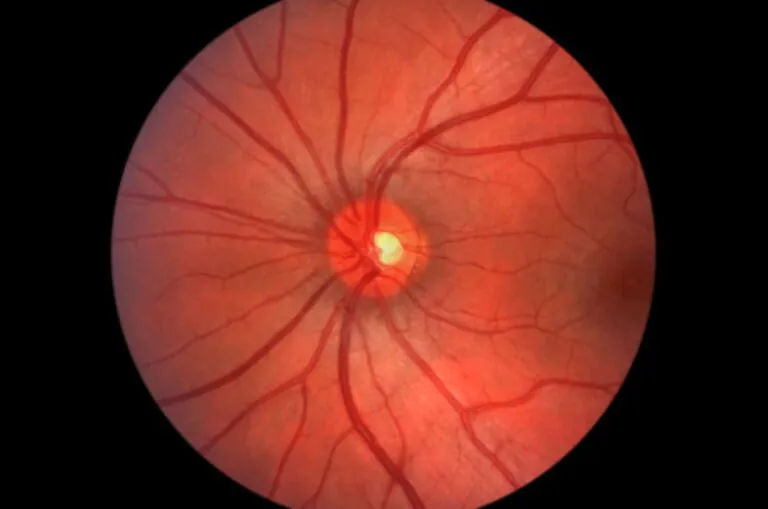 Gene therapy: glaucoma and dementia