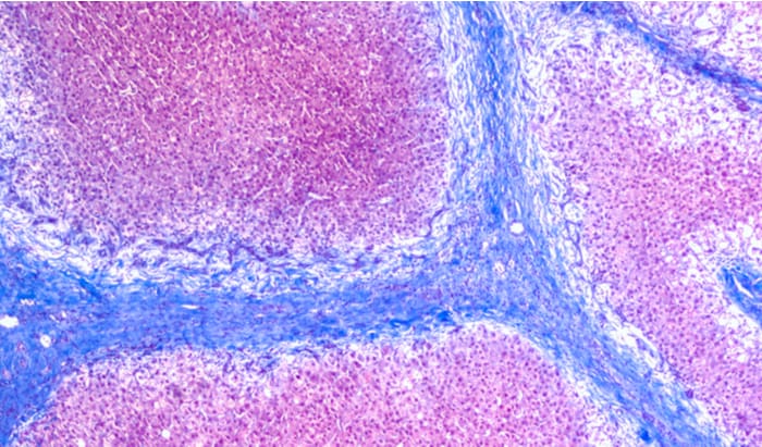 liver cirrhosis