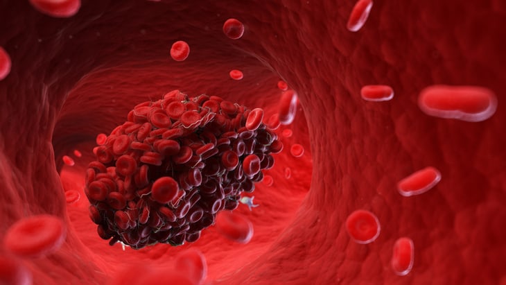 Blood clots and lung injuries found patients who have died of Covid-19