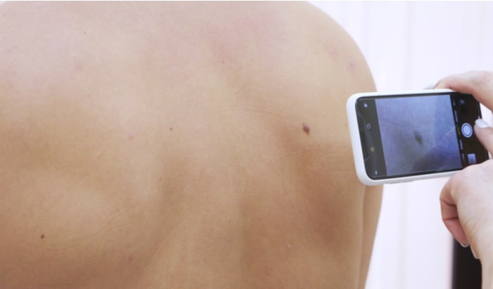 Patient-led surveillance shows promise for melanoma care