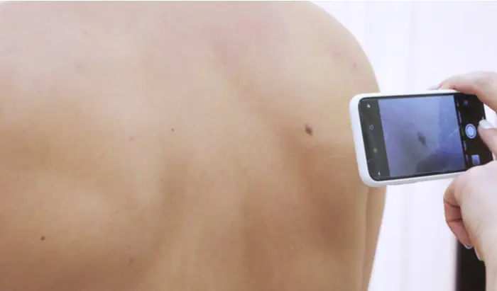 Patient-led surveillance shows promise for melanoma care patient-led