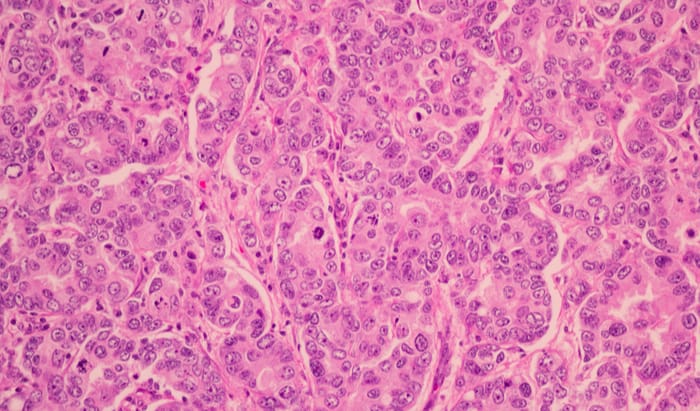 $8M from Snow Medical Research Foundation for Breast Cancer