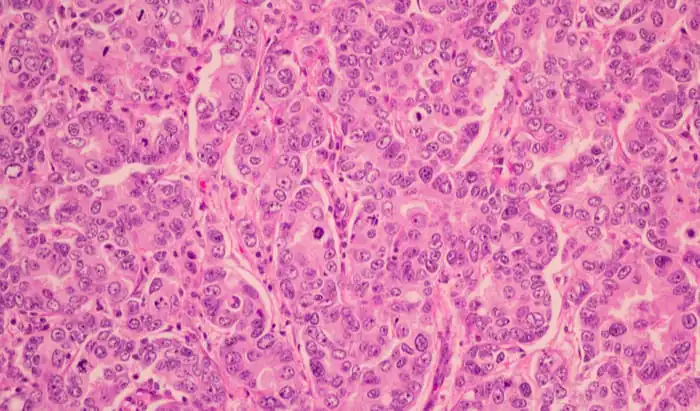 $8M from Snow Medical Research Foundation for Breast Cancer Snow Medical Foundation