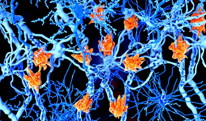 Working to stop MS in its tracks
