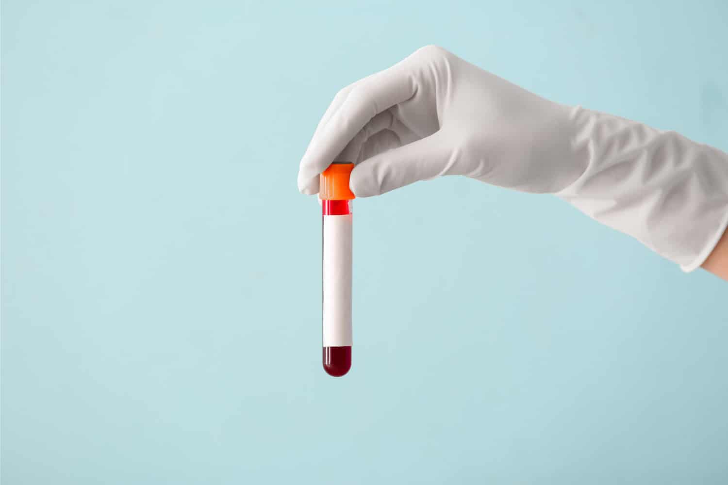 ‘Transformative’ blood test to identify molecular signatures dementia
