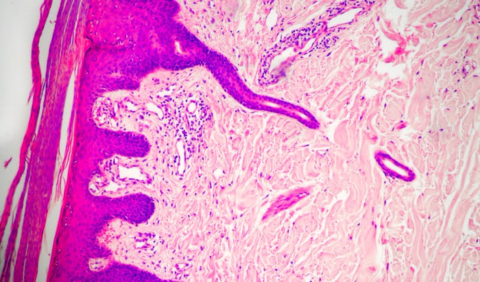 New factor in the development of psoriasis