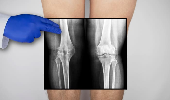 Cartilage matrix as natural biomaterial for cartilage regeneration
