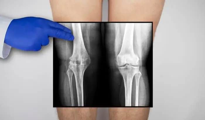 Cartilage matrix as natural biomaterial for cartilage regeneration cartilage