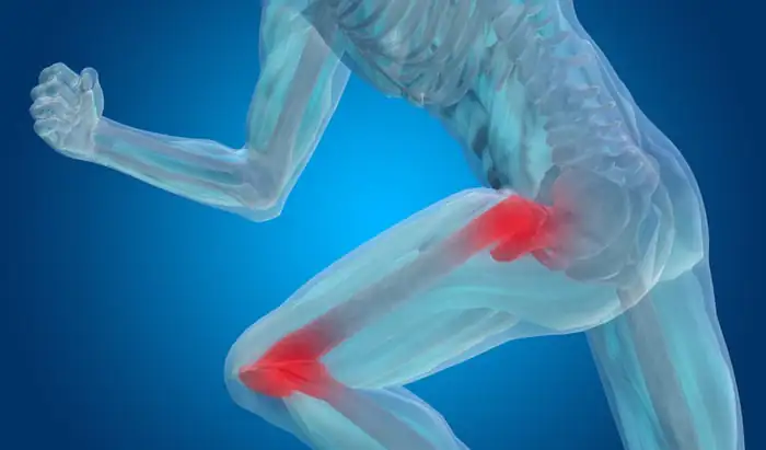 ACL rupture