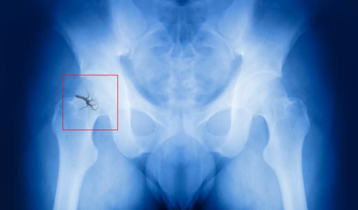 Hip fracture risk linked to nanoscale bone inflexibility