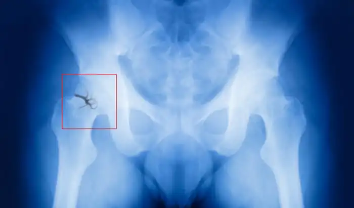 Hip fracture risk linked to nanoscale bone inflexibility broken hip