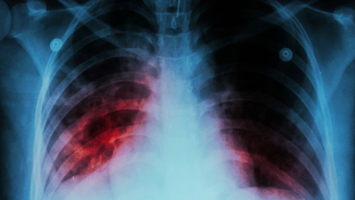 Signs of ingested TB