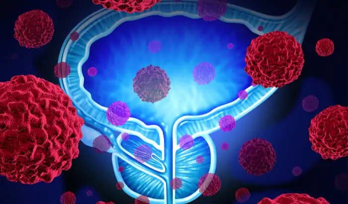 Cause of metastasis in prostate cancer discovered metastasis
