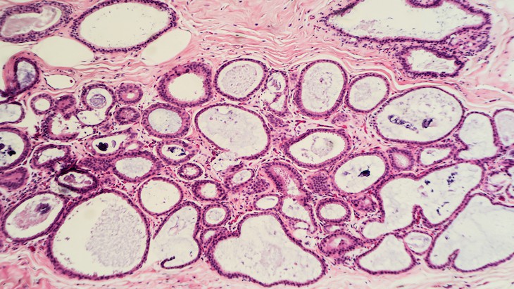 The biopsy debate