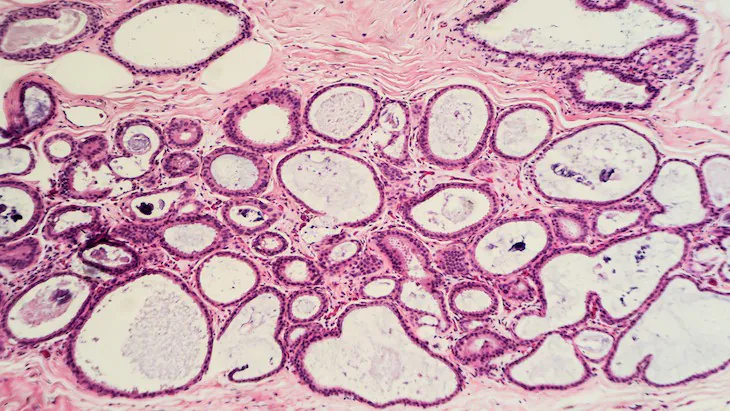 The biopsy debate