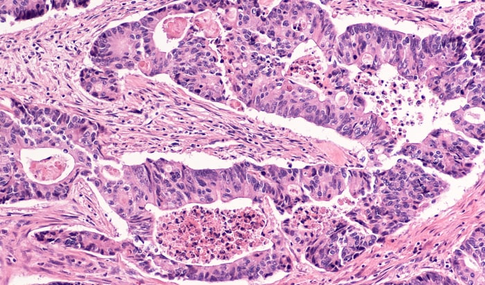 Improving outcomes for bowel cancer