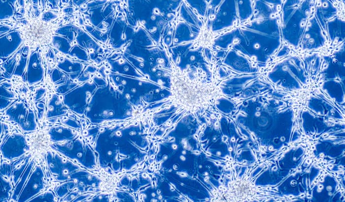 Glioblastoma and autism