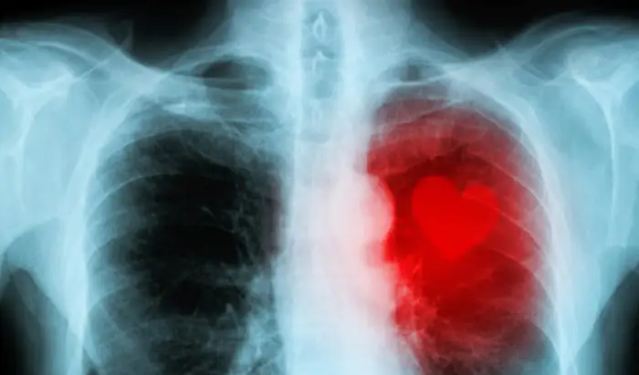 Premature cardiovascular disease mortality
