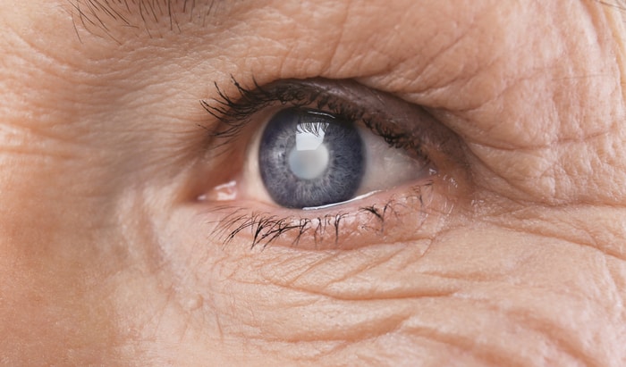Alzheimer’s and cataract surgery