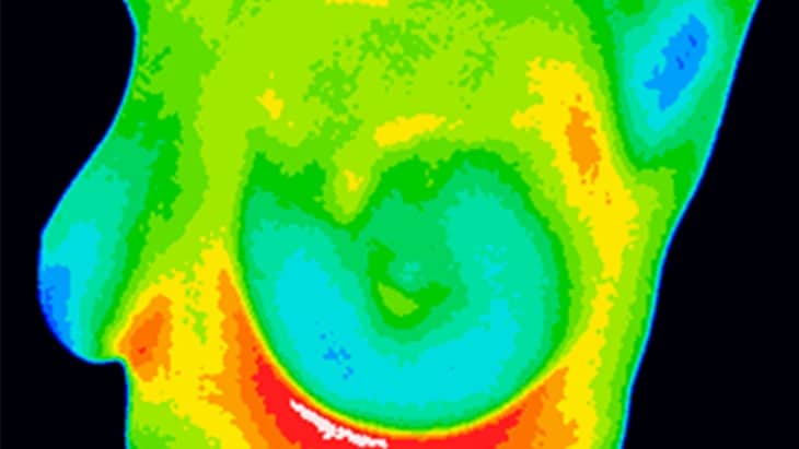 Can Thermal Imaging Detect Breast Cancer?