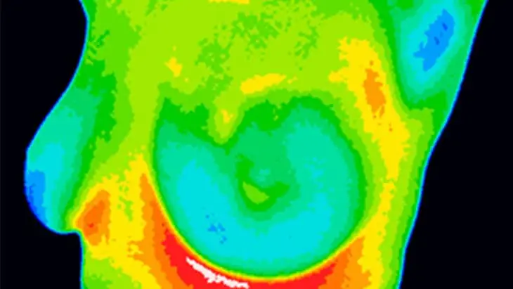 Can Thermal Imaging Detect Breast Cancer?