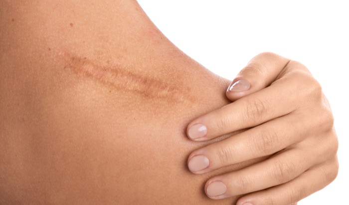New way to reduce scarring