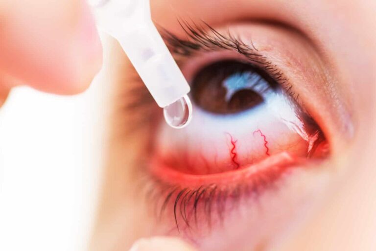 Eye inflammation reportedly linked to Covid-19