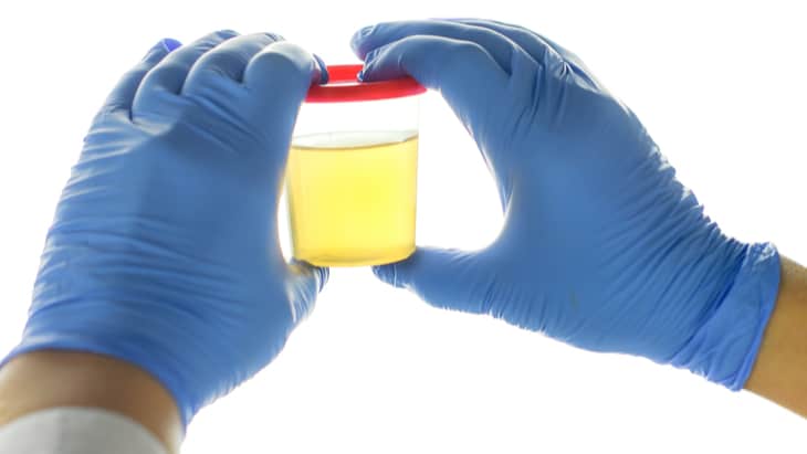 How to lessen contamination rates in urine samples